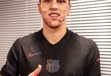 La escalofriante imagen de Cubarsí, el defensor del Barcelona que recibió una patada en la cara