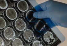 Un adolescente vive cinco años con un balín en la cabeza